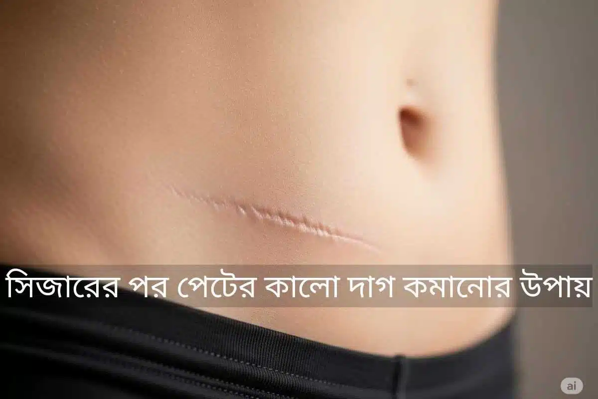 একজন নারীর পেটের নিচের অংশে একটি হালকা সিজারিয়ান দাগ দৃশ্যমান, যা মসৃণ ত্বক দ্বারা পরিবেষ্টিত। এই চিত্রটি সিজারের পরের দাগ এবং তা কমানোর বিভিন্ন চিকিৎসা পদ্ধতির প্রয়োজনীয়তা তুলে ধরে।